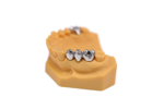 Full Metal Fixed Bridges - Image 2