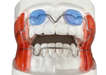 Functional Orthodontic Appliances - Image 2