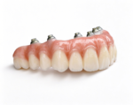 Implant-Supported Fixed Bridges - Image 2