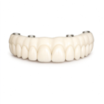PMMA Full-Arch Provisional Restorations - Image 2