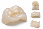 Ceramic Inlays & Onlays - Image 4