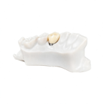 Layered Zirconia Crowns