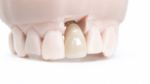 Cement-Retained Implant Crowns - Image 3