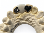 Maryland Adhesive Bridges